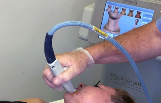 Clinician's hand holding Neogen Plasma device and treating patient's face 