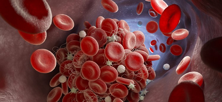 Blood clot image