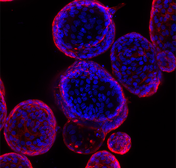 Patient derived ‘mini guts’ - for inherited tumour syndrome research. 