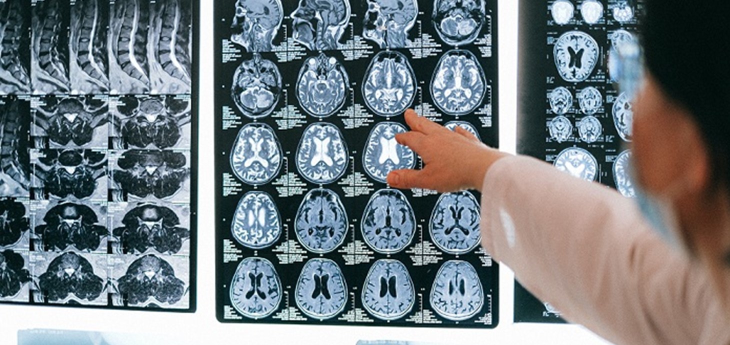 Brain scans: six Swansea University researchers have been awarded funding by Health and Care Research Wales, to investigate topics ranging from sun safety policies in primary schools to the impact of COVID-19 on people with epilepsy.