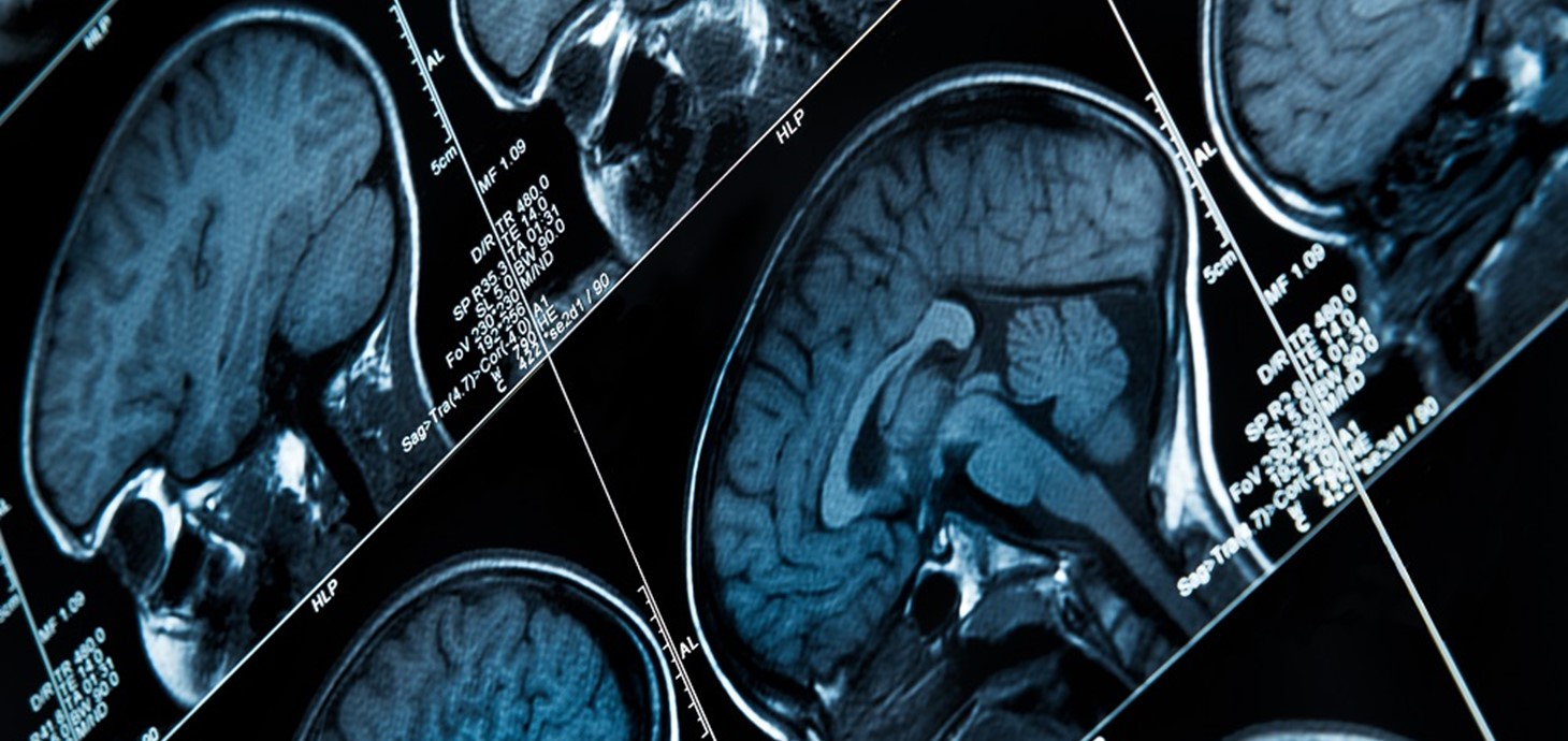 Brain scan: epilepsy is a serious neurological condition that can affect anyone, at any age and from any walk of life.