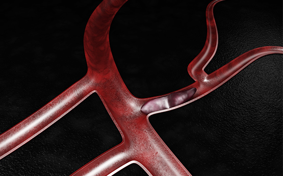 Venous Thromboembolism (VTE) Graphic