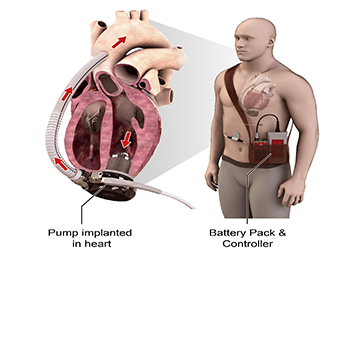 Illustration of how the MiniVAD™ will fit into a patient's heart (left) and the MiniVad™ system (right).